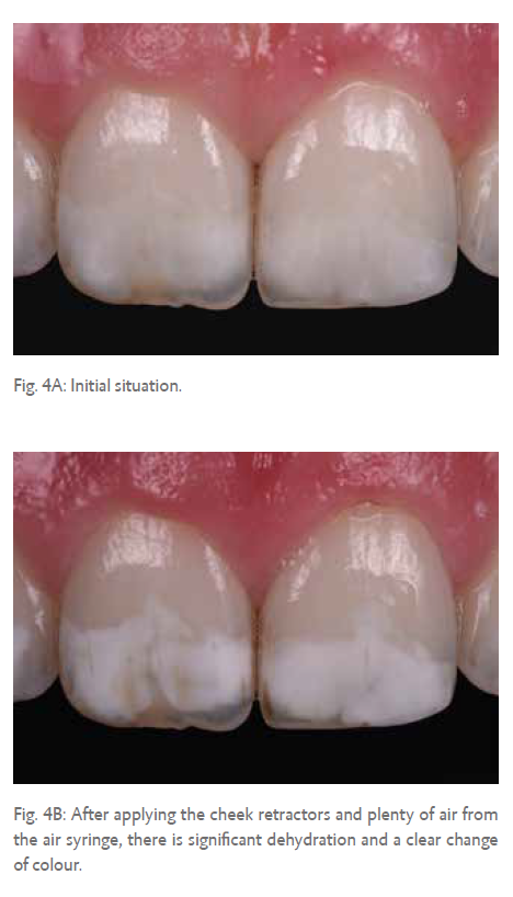 Fig. 4A: Initial situation.   Fig. 4B: After applying the cheek retractors and plenty of air from the air syringe, there is significant dehydration and a clear change of colour.